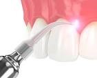 Laser dental tool applying treatment to gums and teeth.